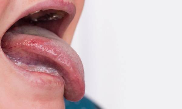 Estas heridas descamadas en el borde de la lengua son una llamada de atención del cuerpo