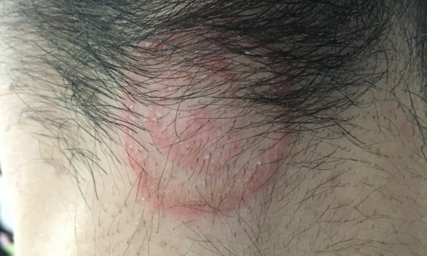 El dermatólogo que detectó el brote de tiña: «Pido a los peluqueros que no rasuren si ven una lesión sospechosa»